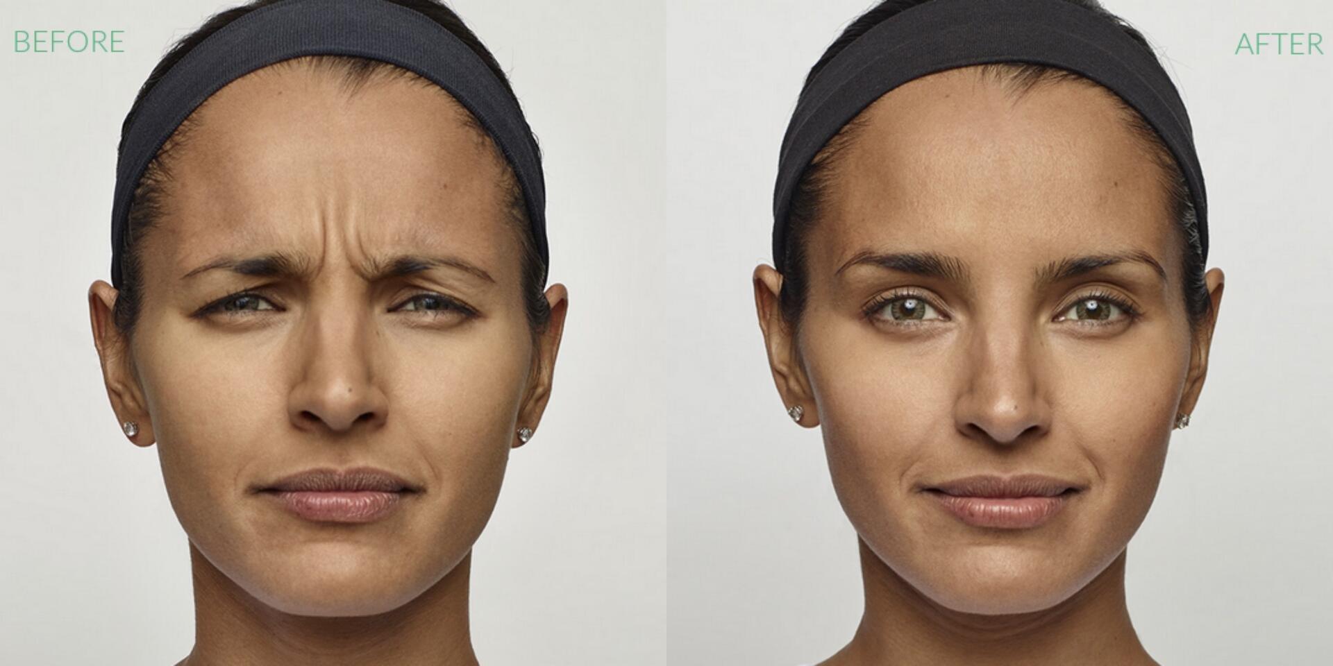 Before and After Image: Dysport - front
