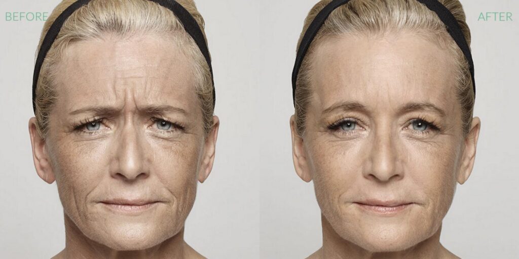 Before and After Image: Dysport - front