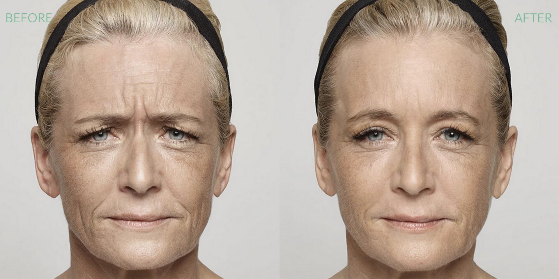 Before and After Image: Dysport - front