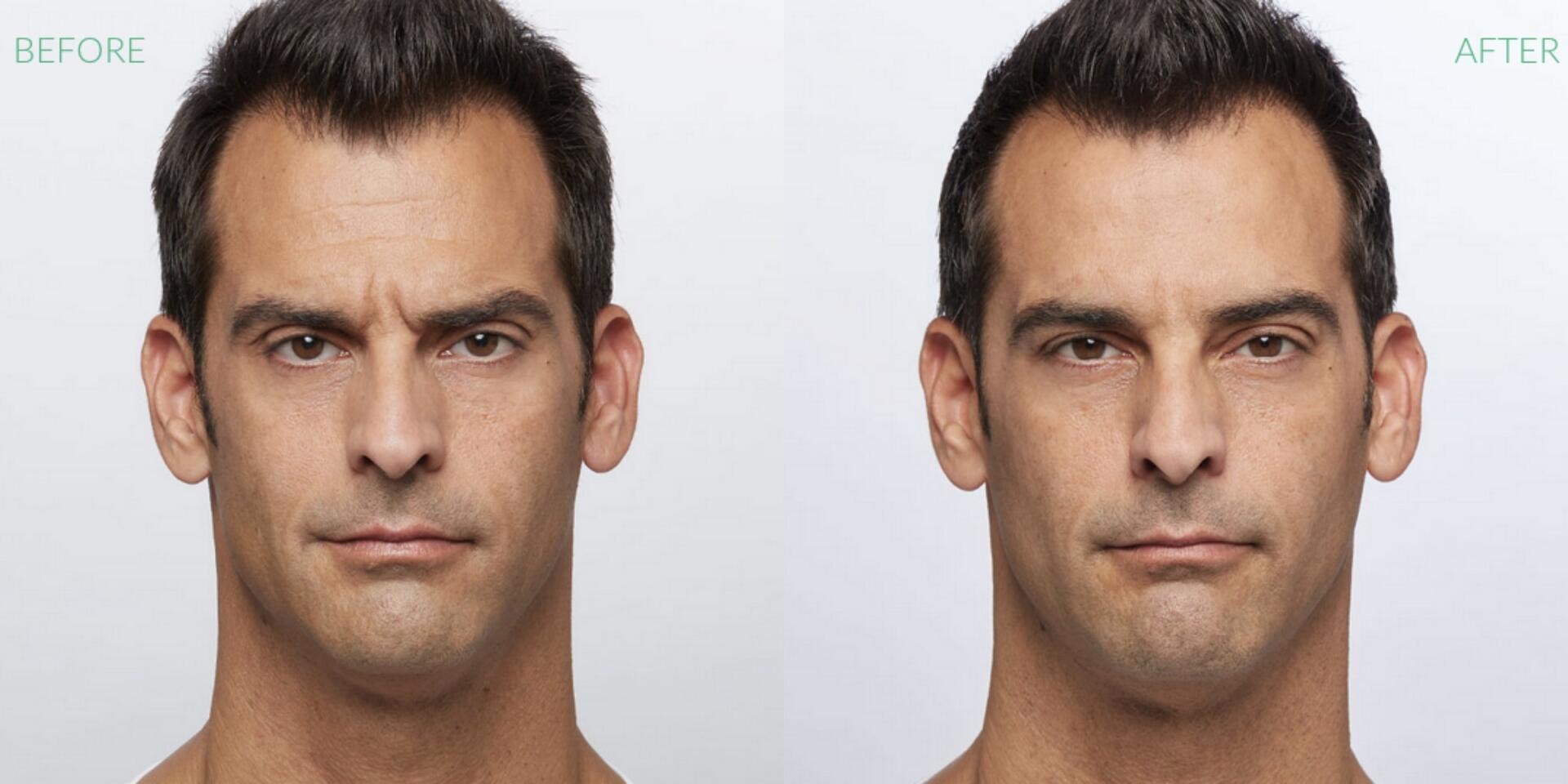 Before and After Image: Dysport - front