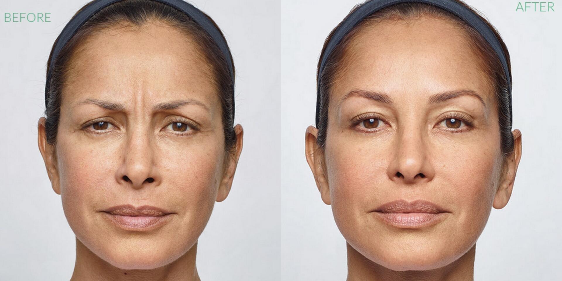 Before and After Image: Dysport - front