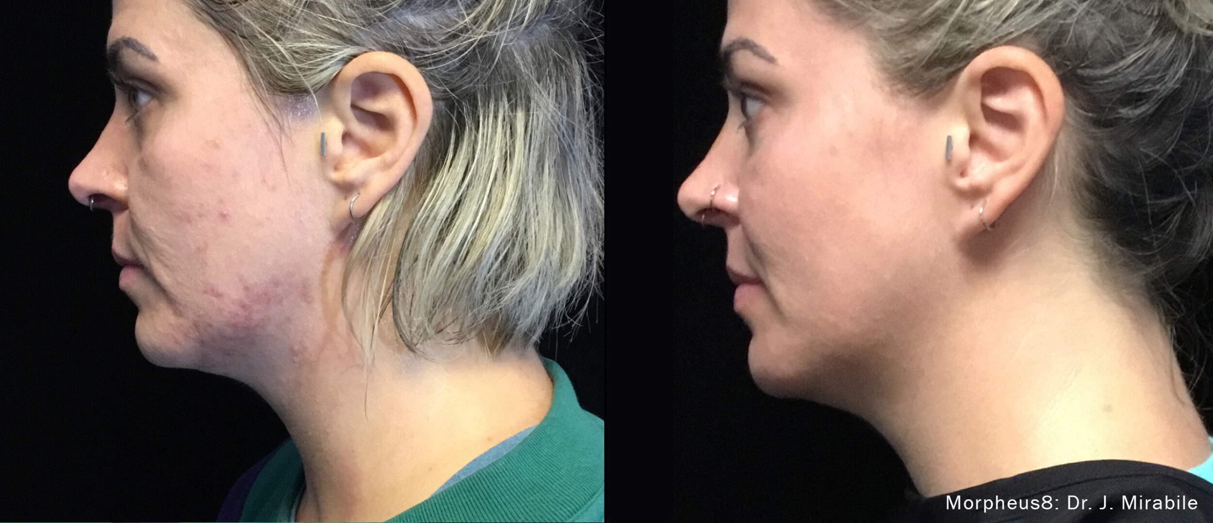 Before and After Image: Face Resurfacing - left-side