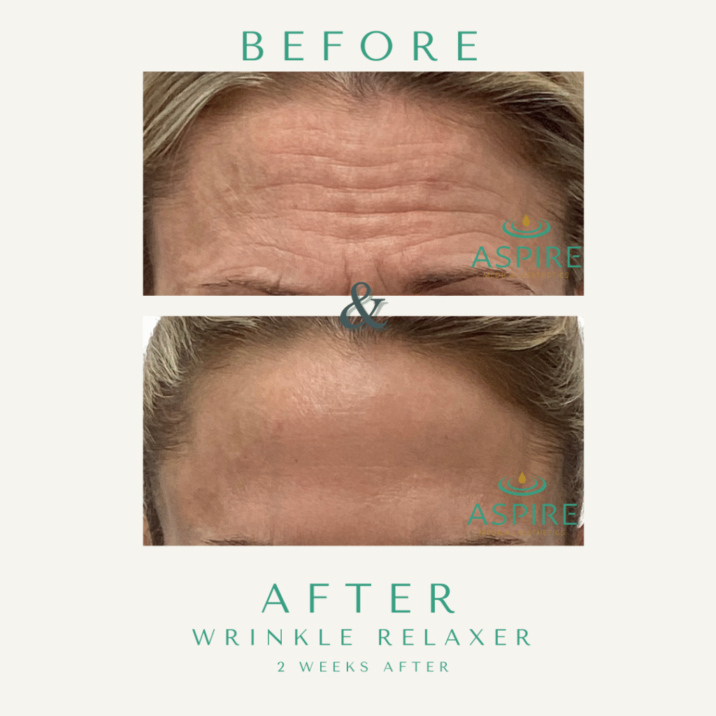 Before and After Image: Botox - front
