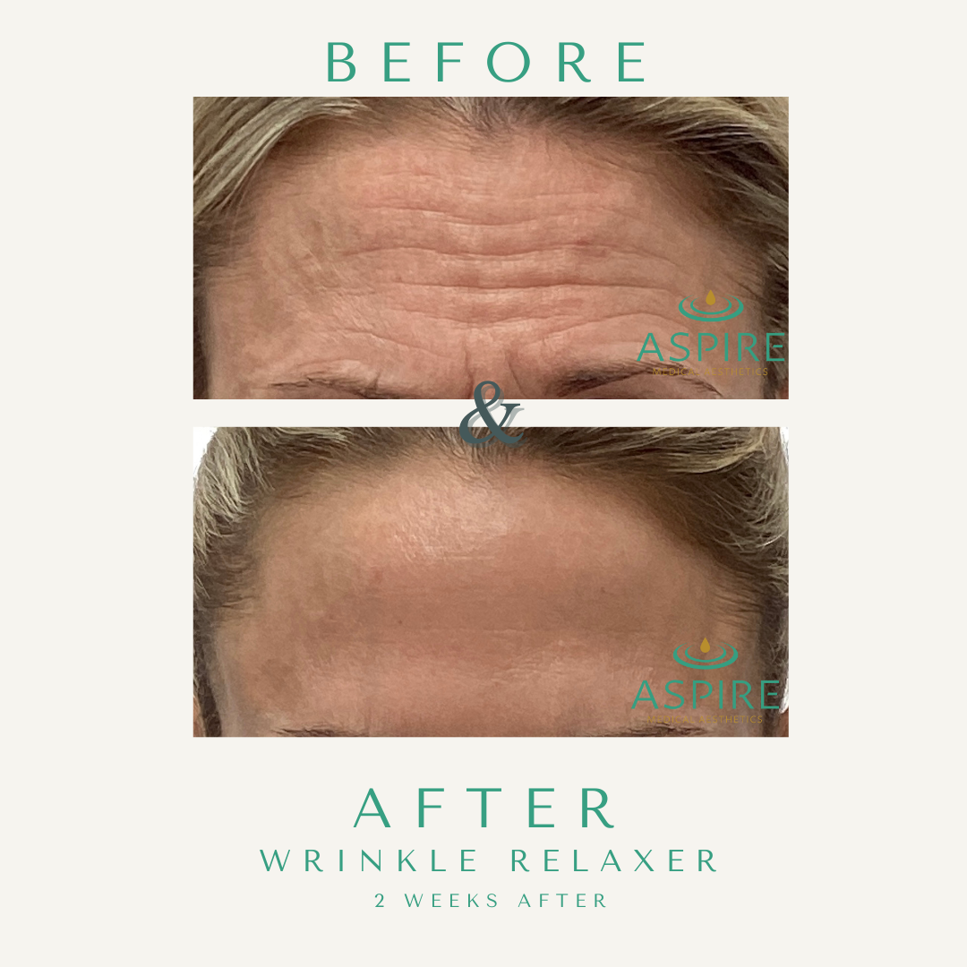 Before and After Image: Botox - front