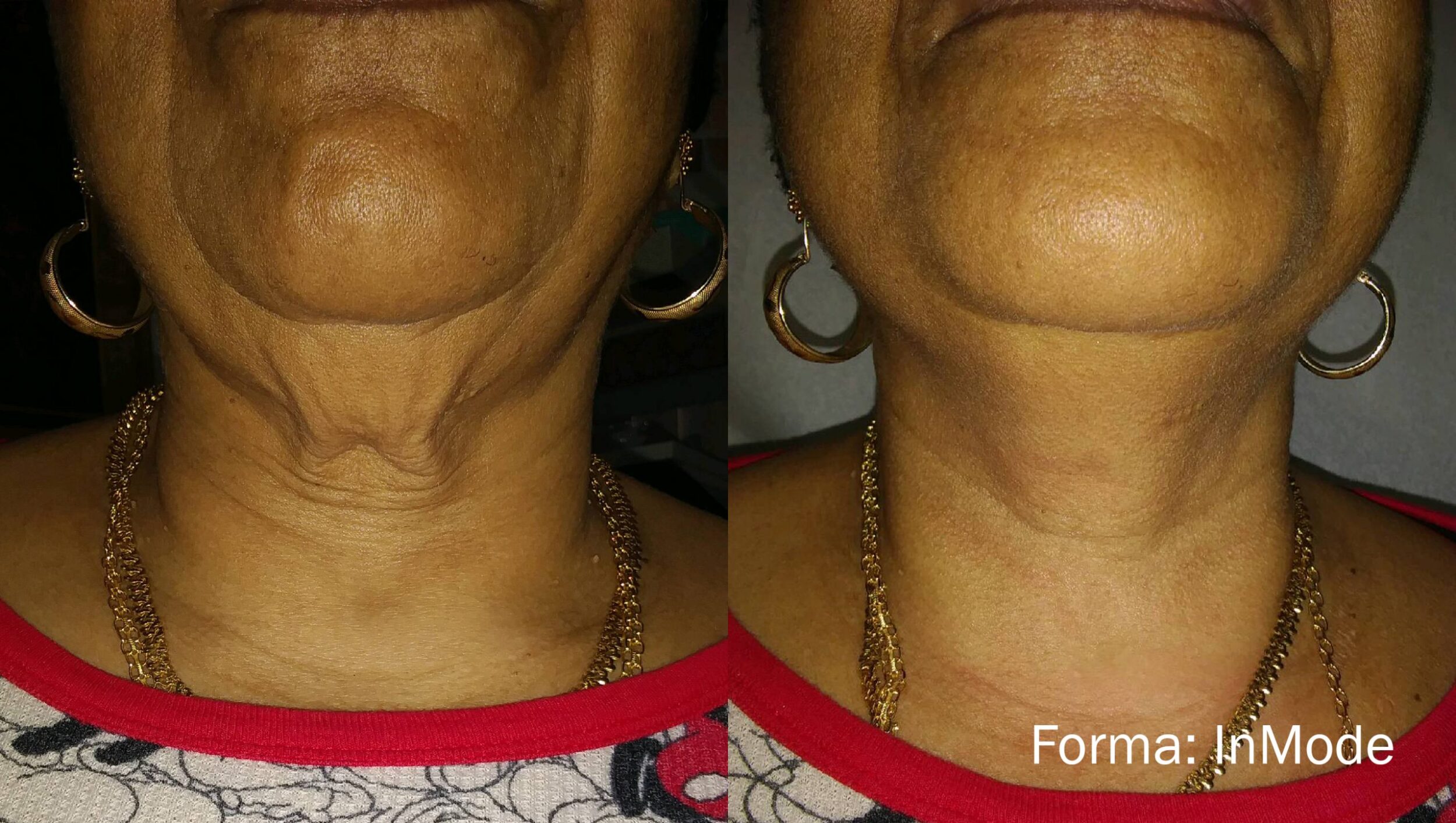 Before and After Image: Forma - front
