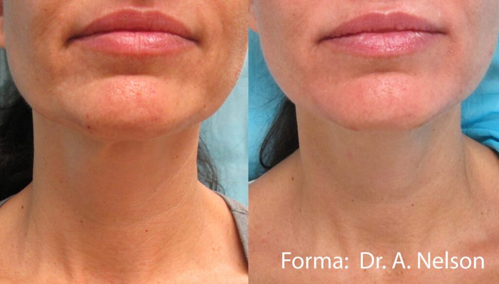 Before and After Image: Forma - front