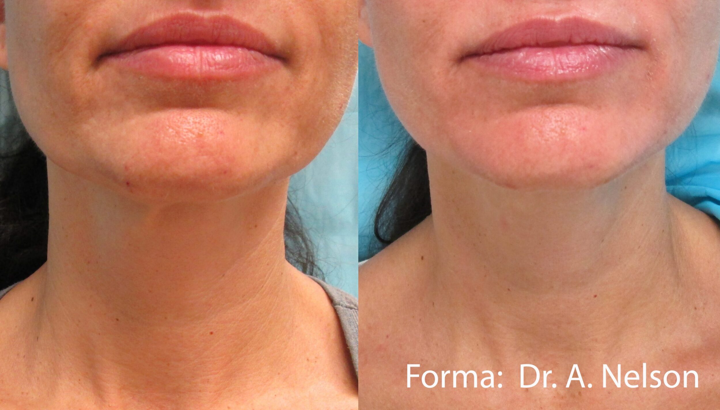 Before and After Image: Forma - front