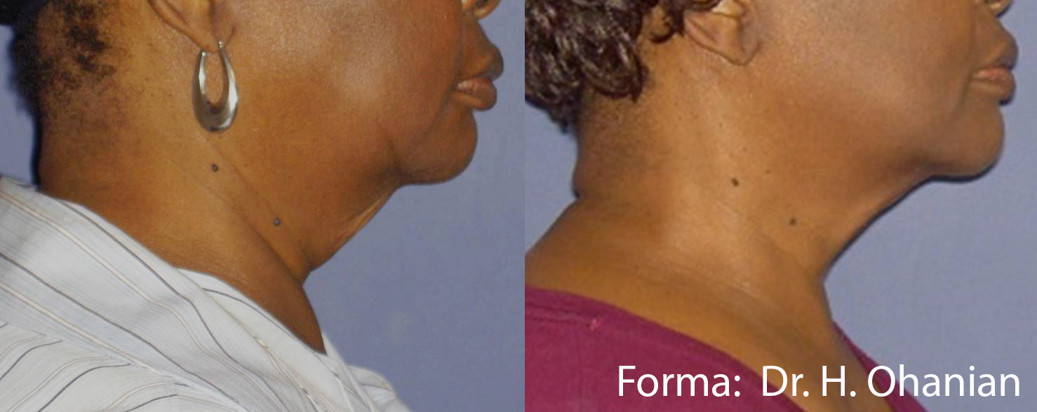 Before and After Image: Forma - right-side