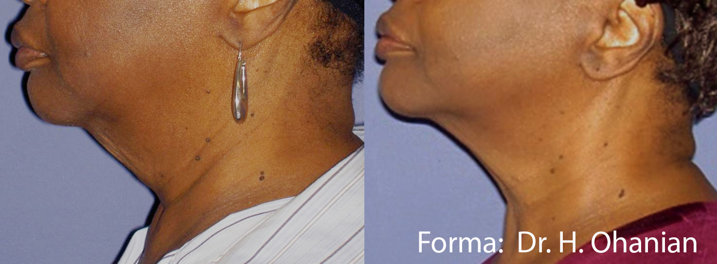 Before and After Image: Forma - left-side