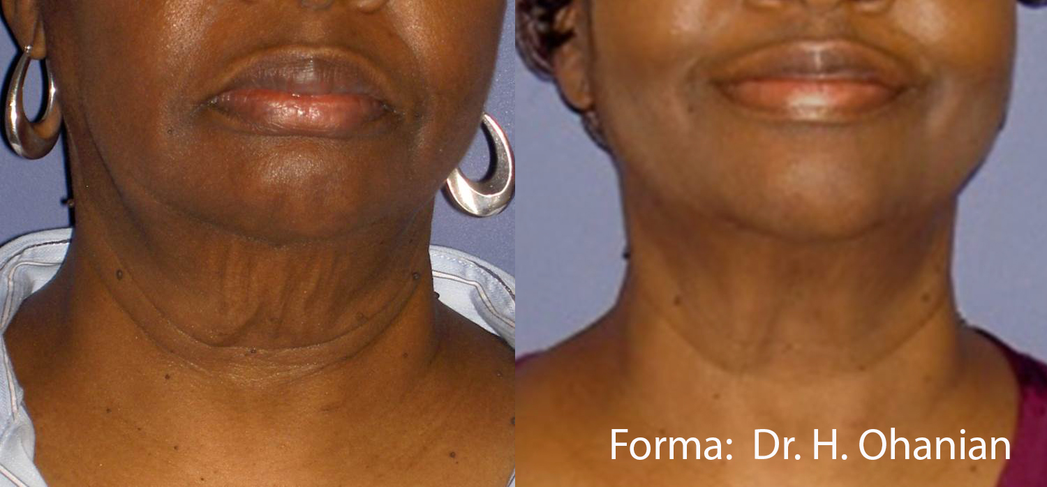Before and After Image: Forma - front
