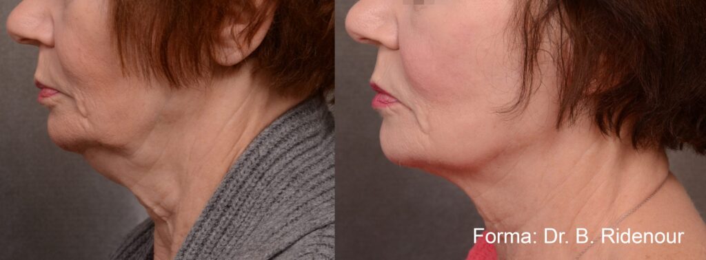 Before and After Image: Forma - left-side