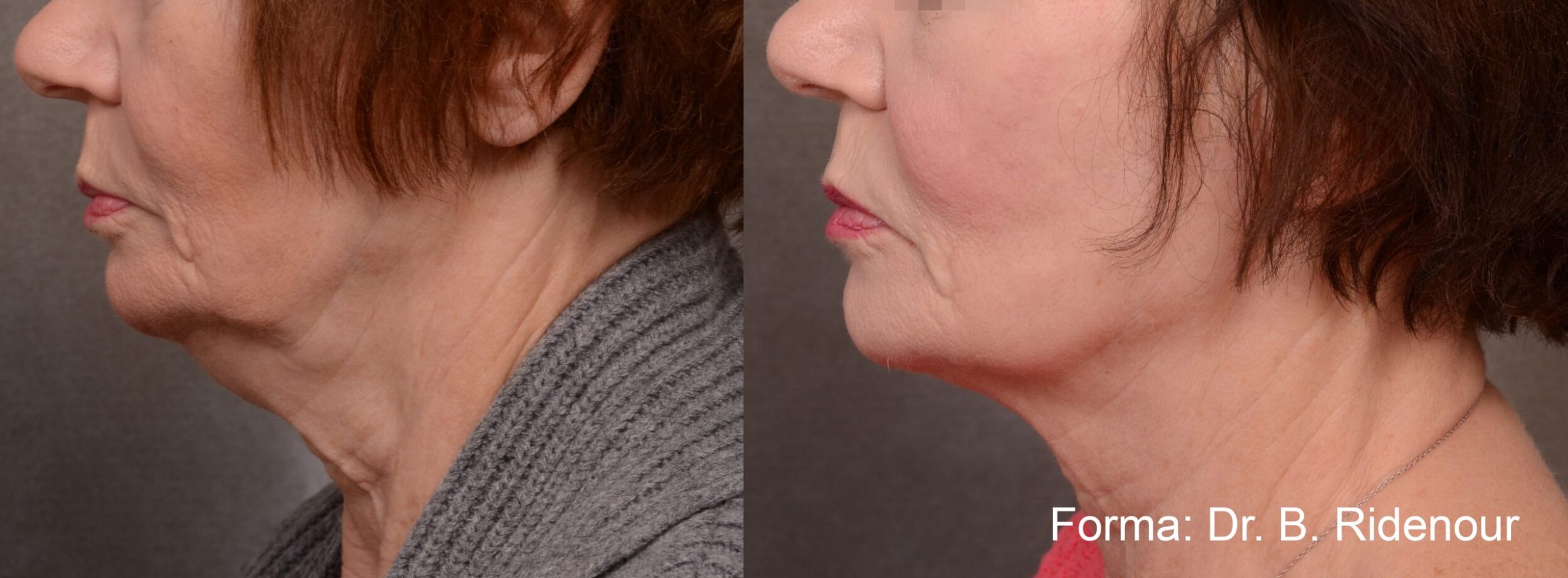 Before and After Image: Forma - left-side