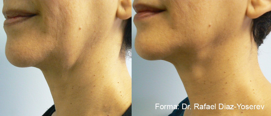 Before and After Image: Forma - left-front-oblique