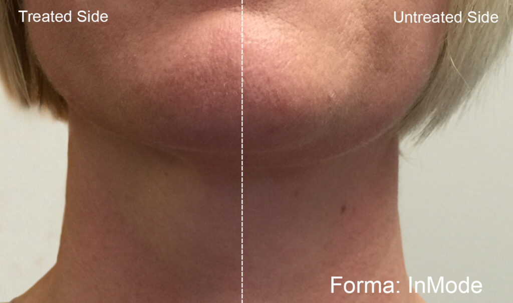 Before and After Image: Forma - front