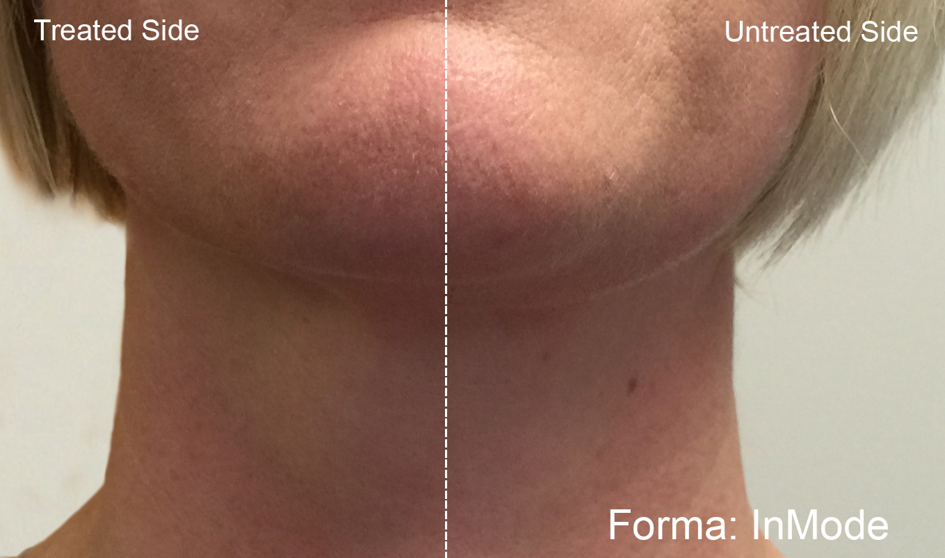 Before and After Image: Forma - front