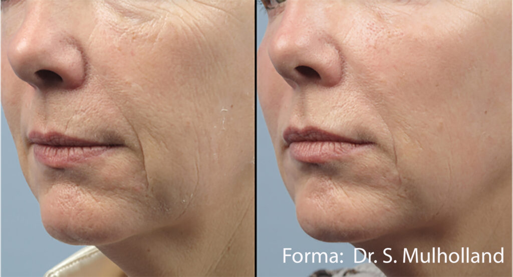 Before and After Image: Forma - left-front-oblique