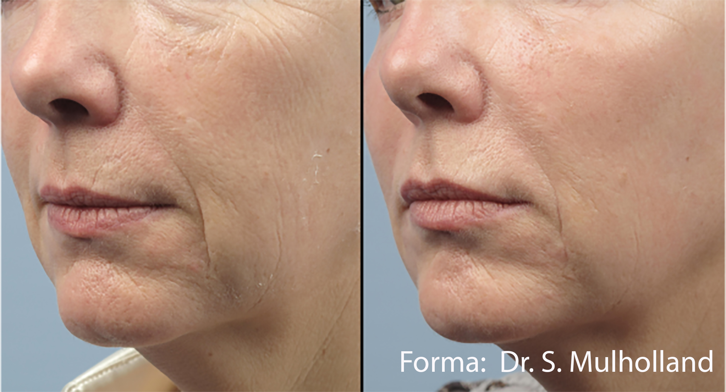 Before and After Image: Forma - left-front-oblique