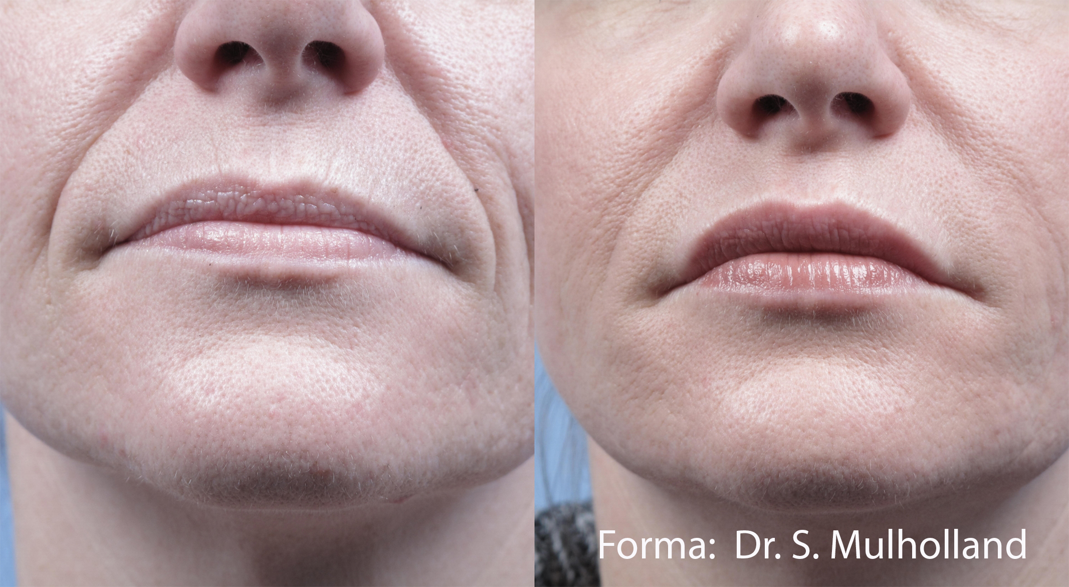 Before and After Image: Forma - front