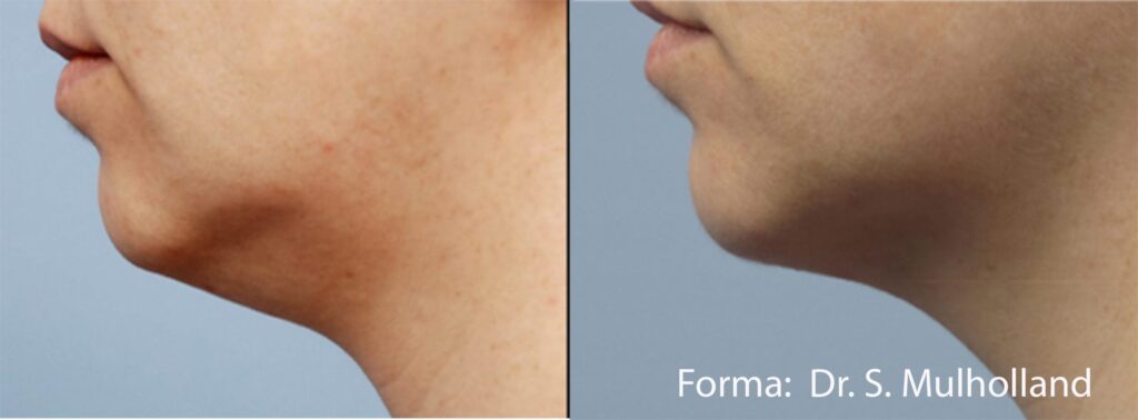 Before and After Image: Forma - front