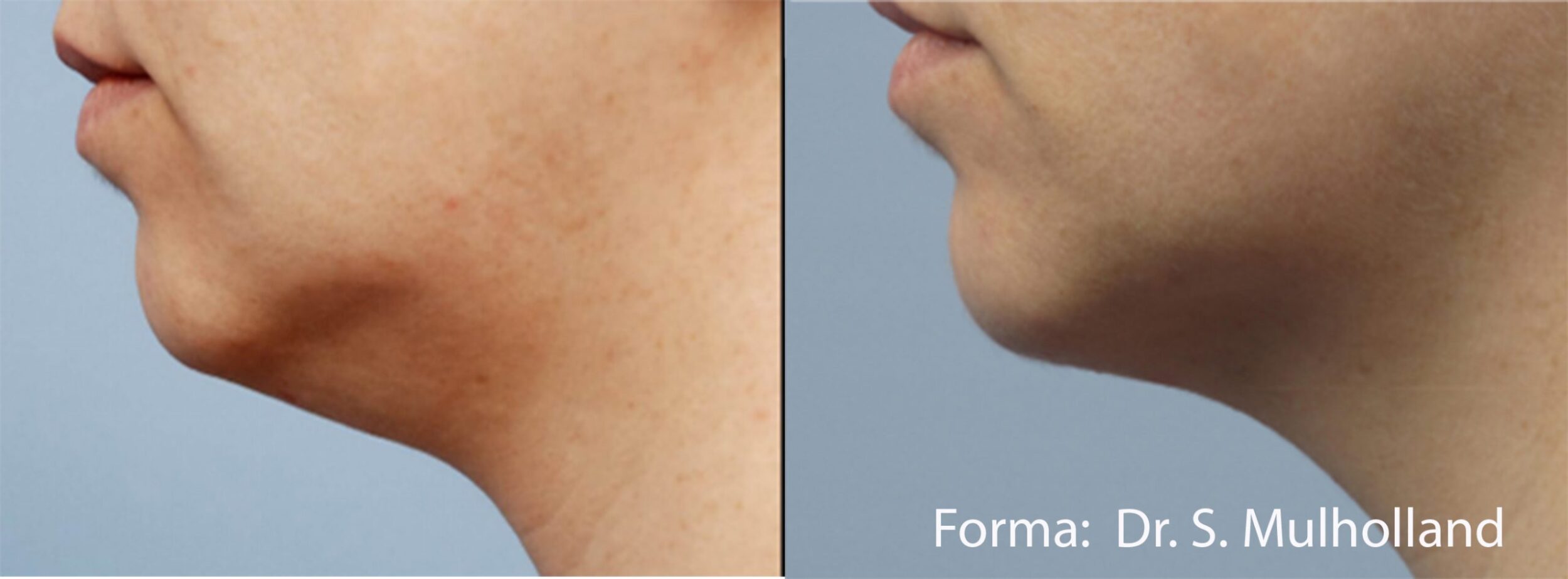 Before and After Image: Forma - front