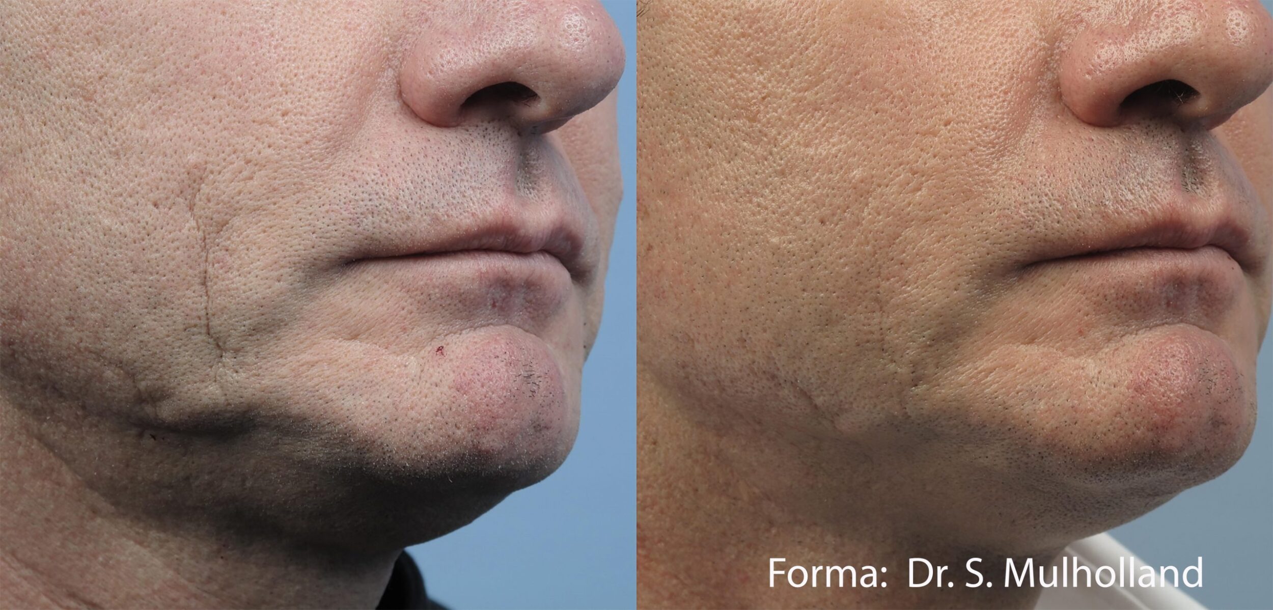 Before and After Image: Forma - right-front-oblique