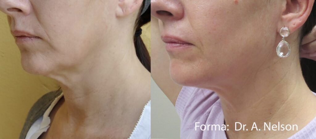 Before and After Image: Forma - left-front-oblique
