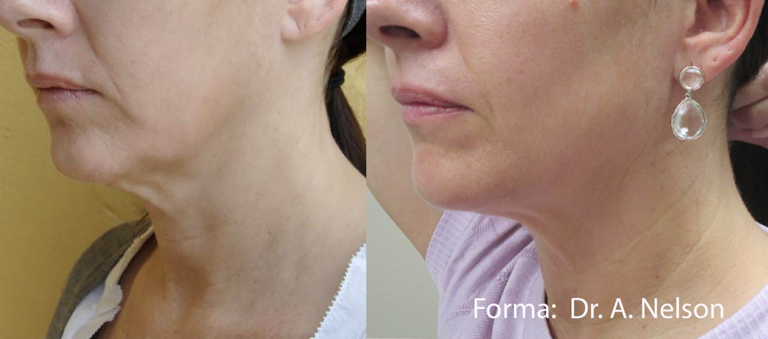 Before and After Image: Forma - left-front-oblique