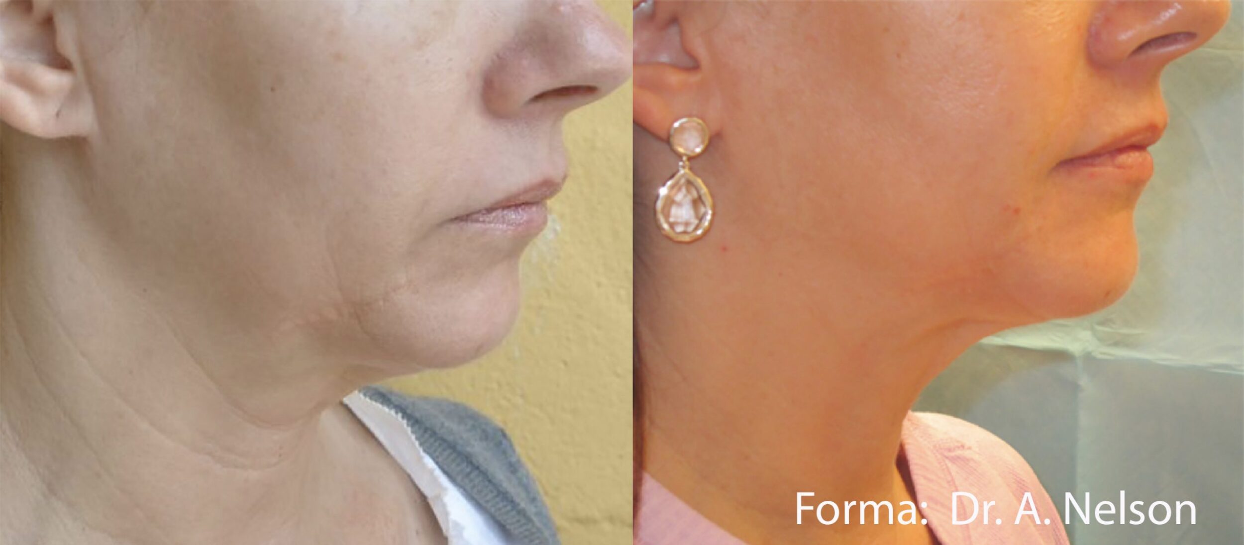Before and After Image: Forma - right-front-oblique