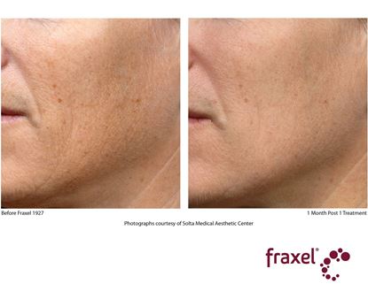 Before and After Image: Fraxel - left-front-oblique