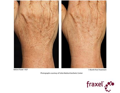 Before and After Image: Flex - back