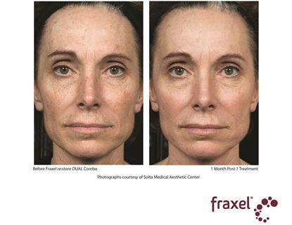 Before and After Image: Flex - front