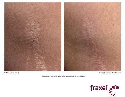 Before and After Image: Flex - front