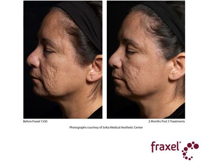 Before and After Image: Flex - left-side