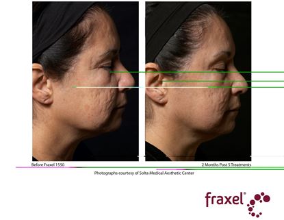 Before and After Image: Flex - right-side