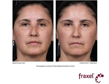 Before and After Image: Flex - front