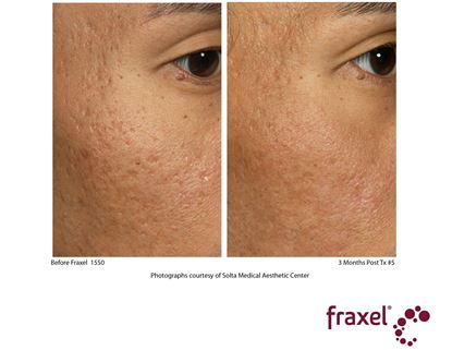Before and After Image: Flex - right-front-oblique