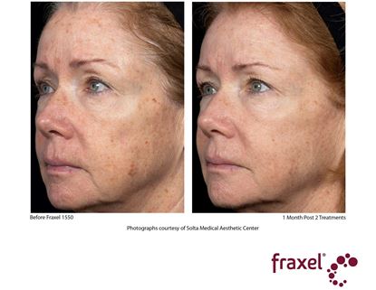 Before and After Image: Fraxel - left-front-oblique
