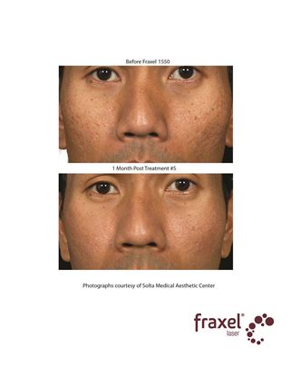 Before and After Image: Flex - front