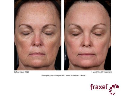 Before and After Image: Fraxel - front