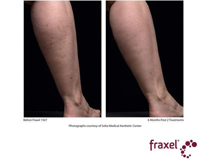 Before and After Image: Flex - back
