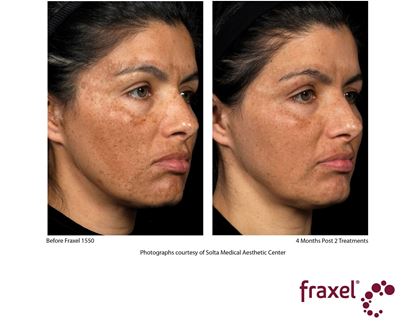 Before and After Image: Flex - right-front-oblique
