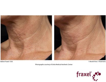 Before and After Image: Flex - left-front-oblique