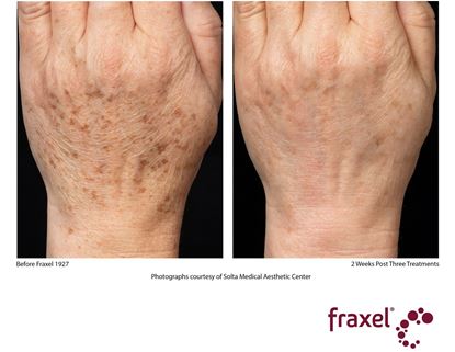 Before and After Image: Fraxel - back