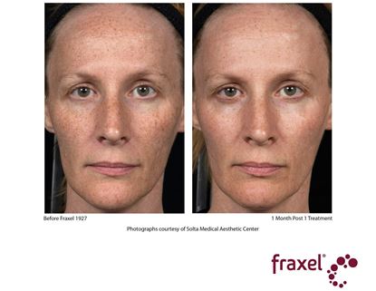 Before and After Image: Fraxel - 