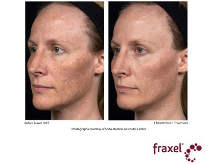 Before and After Image: Fraxel - left-front-oblique