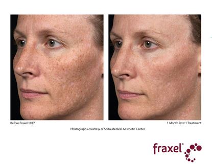 Before and After Image: Fraxel - 