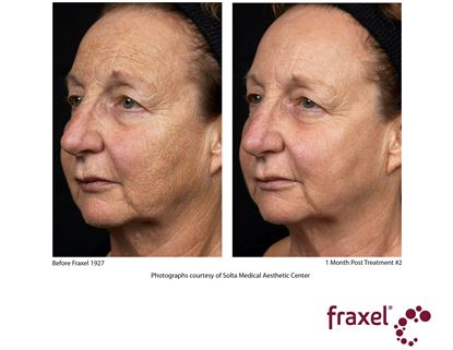Before and After Image: Fraxel - left-front-oblique