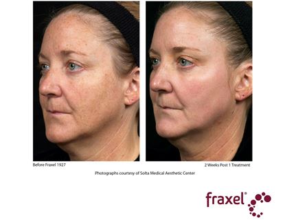 Before and After Image: Fraxel - left-front-oblique