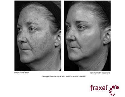 Before and After Image: Fraxel - 