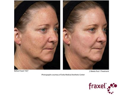 Before and After Image: Fraxel - right-front-oblique